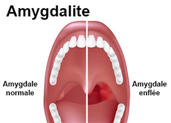 Qu est ce que les amygdales