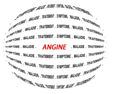 Angine : virale, bactérienne, symptômes, prévention, traitements