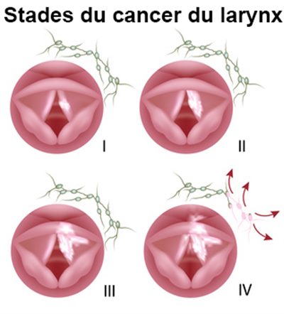 Cancer du larynx