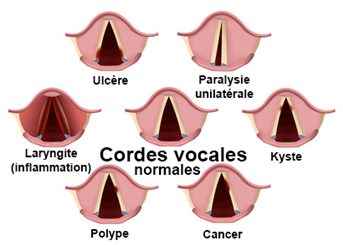 problèmes de cordes vocales