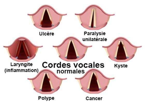 Laryngite De L Adulte Symptomes Traitement Definition Docteurclic Com