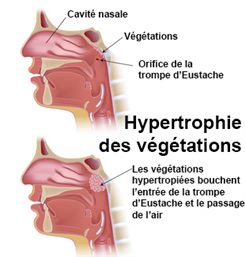 hypertrophie des végétations