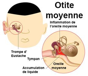 otite moyenne