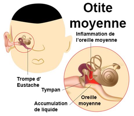 Otite de l'adulte