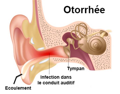 Otorrhée