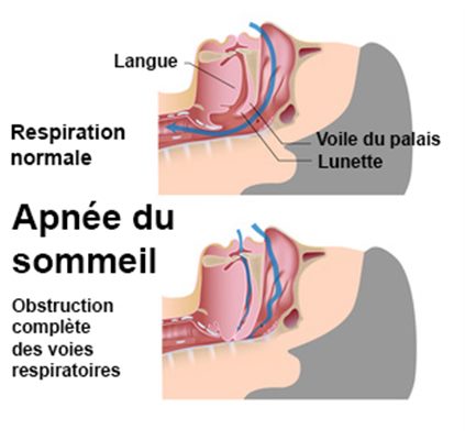 Traitement des apnées hypopnées du sommeil