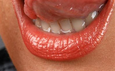 Lithiase salivaire : symptômes, traitement, définition ...
