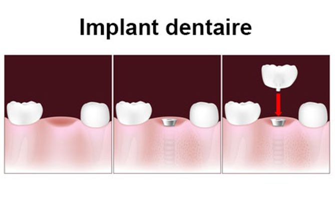 Implants dentaires