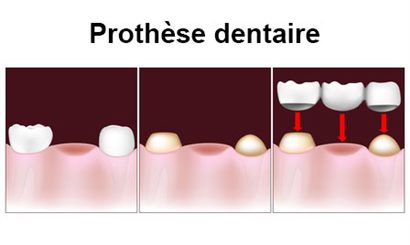 prothèse dentaire