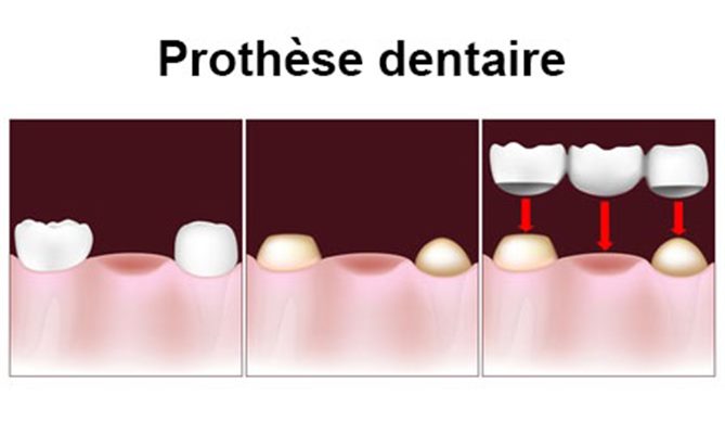 Prothèses dentaires