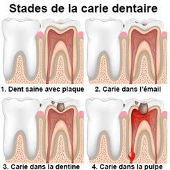 carie dentaire