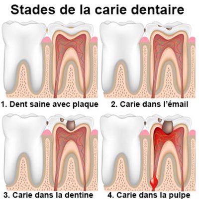 Que faire en cas de carie dentaire ?