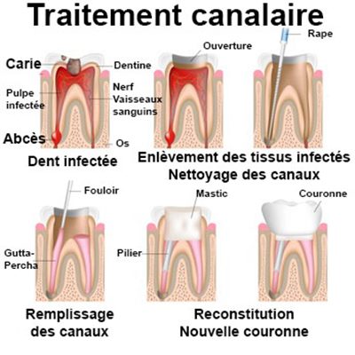 Reconstitution de la dent