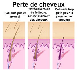 perte de cheveux