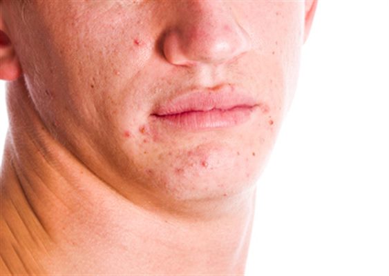 Que faire en cas  d'acné ?