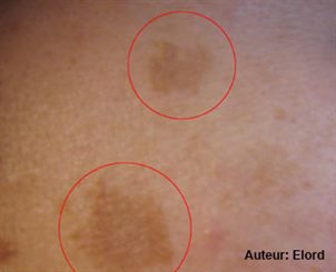 melasma
