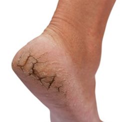 crevasses au talon