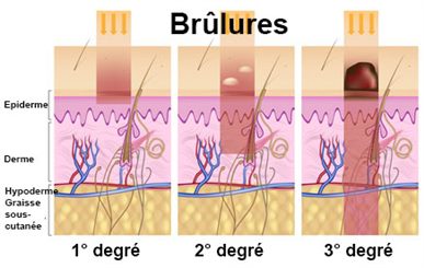 types de brûlures