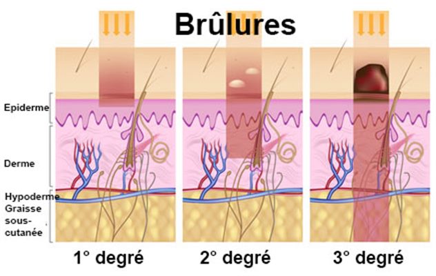 Que faire en cas  de brûlure chez l'enfant ?