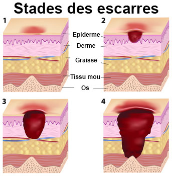 Risque d'escarre def