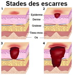 escarres