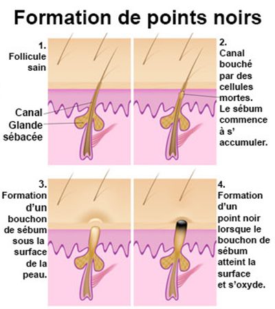 Points noirs, enlever les points noirs : symptômes, traitement ...