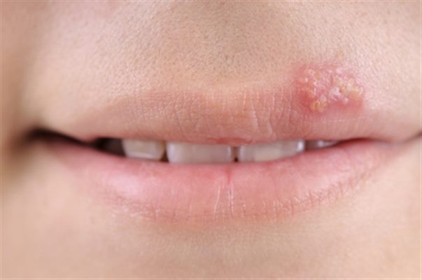 Que faire en cas de bouton de fièvre (herpès labial) ?