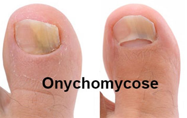 Onychomycose Symptomes Traitement Definition Docteurclic Com