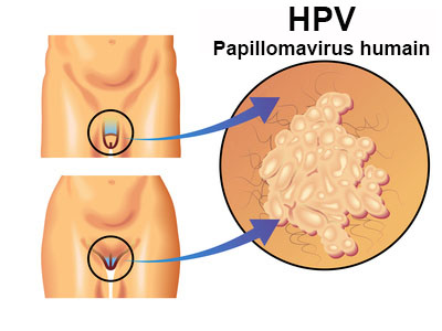 Papillomavirus humains c est quoi, Papillomavirus femme c est quoi