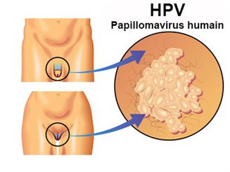 papillomavirus maladie