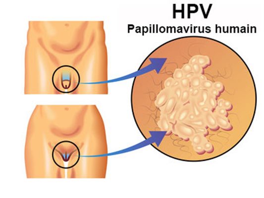 virus papiloma transmision)