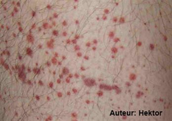 purpura