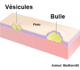 vésicules et bulles