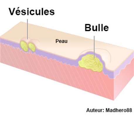 Pemphigus