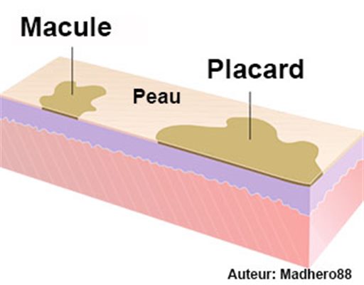 Macules et placards