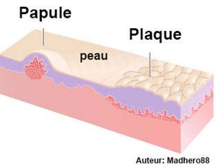 papules et plaques