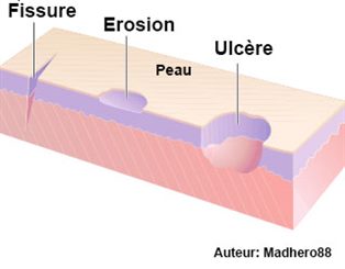fissure, érosions et ulcères