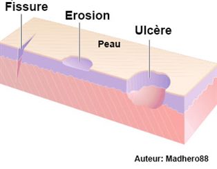 Comme des griffures de chat sur la peau - docteurclic.com