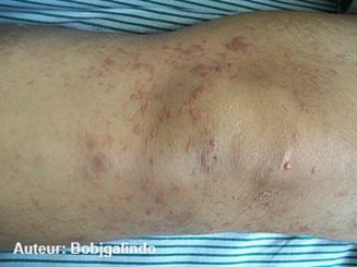 mycosis fongoïde