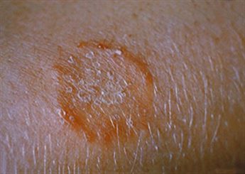 dermatophytose