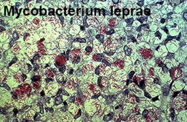 mycobactérium leprae