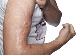 Suites Des Brulures Symptomes Traitement Definition Docteurclic Com