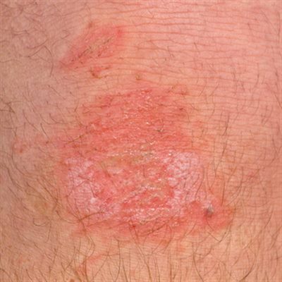 Lésions de la peau et excoriations : définition - docteurclic.com