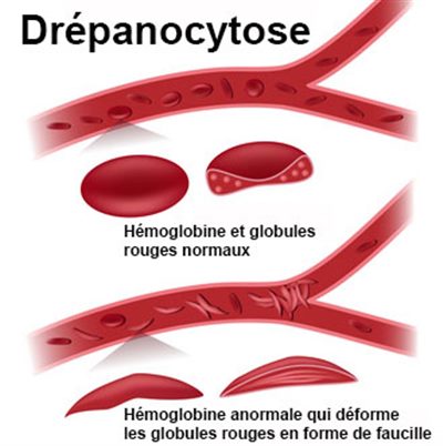 Drépanocytose