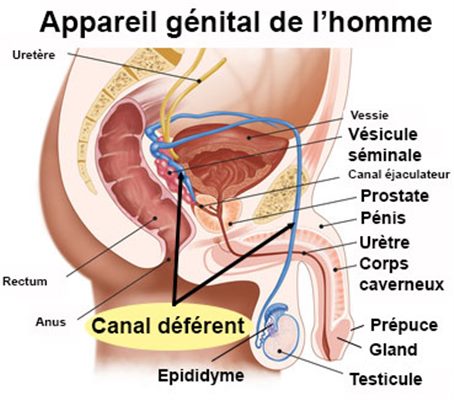 Inflammation cordon spermatique