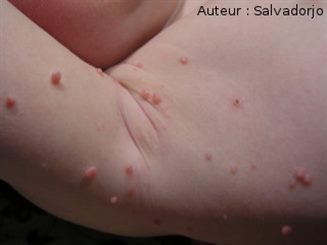 molluscum contagiosum