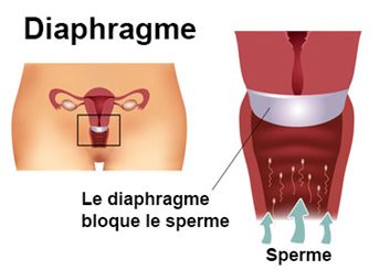diaphragme contraceptif