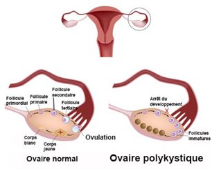 ovaire polykystique