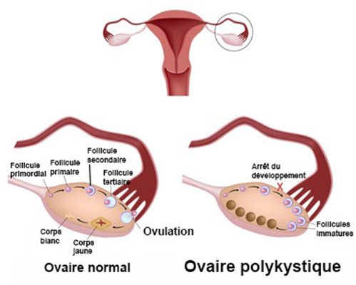 Ovaires polykystiques SOPK et infertilité