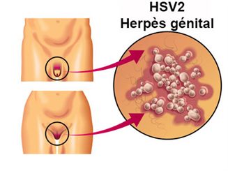 herpès génital